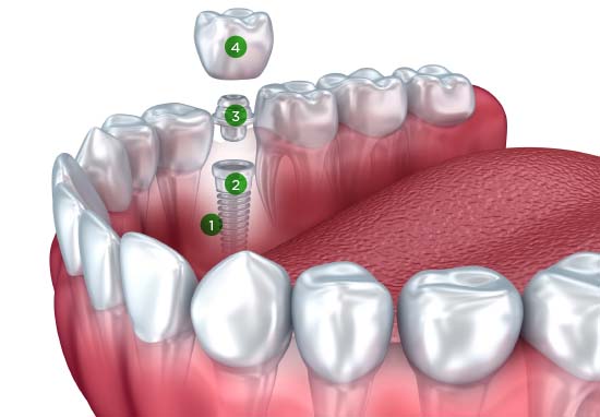 Does Delta Dental Cover Implants in Usa?  